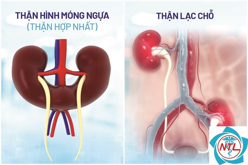 dị tật thận bẩm sinh - Image 1
