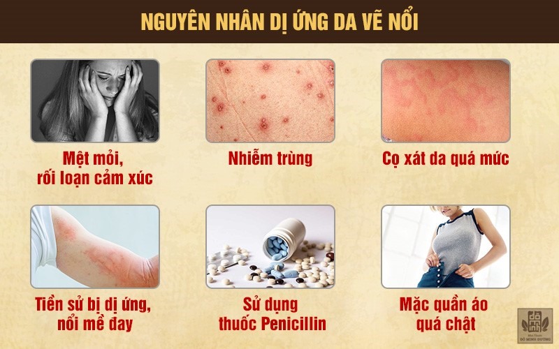 dị ứng da - Image 2