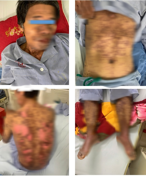 dị ứng thuốc gây tổn thương da