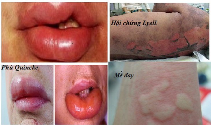 dị ứng thuốc trên da - Image 4