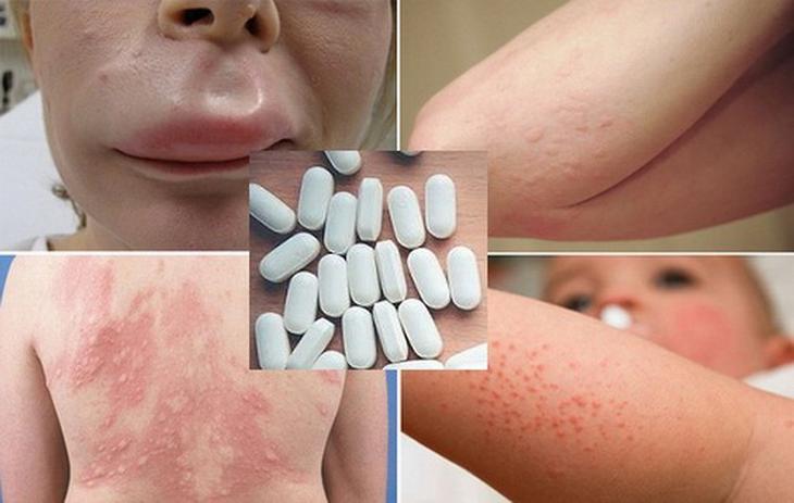 dị ứng thuốc trên da