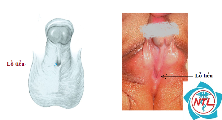 dị vật đường tiết niệu - Image 3