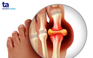 điều trị bệnh gout