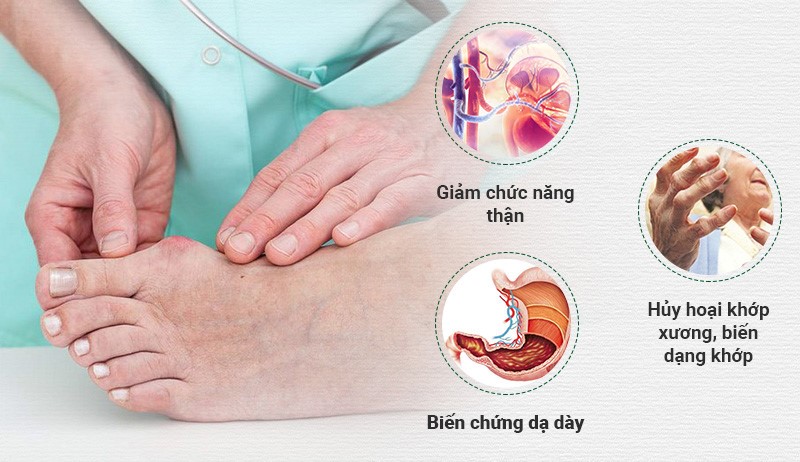 điều trị bệnh gout - Image 4