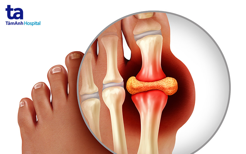 điều trị bệnh gout