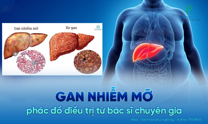 điều trị gan nhiễm mỡ - Image 3