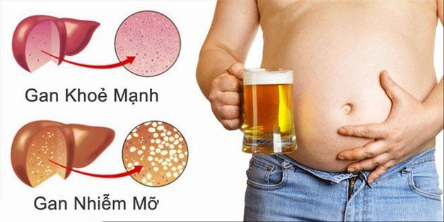 điều trị gan nhiễm mỡ - Image 5