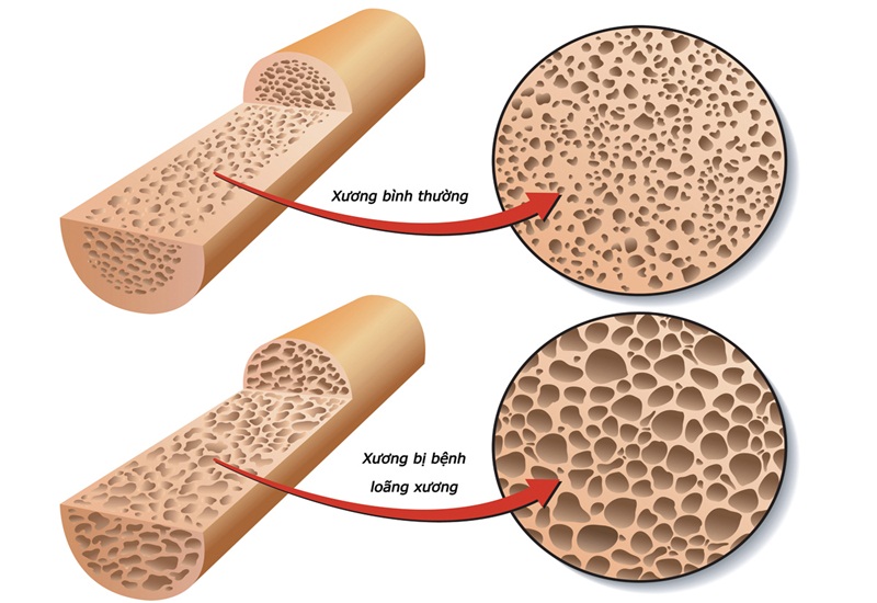 điều trị loãng xương - Image 1