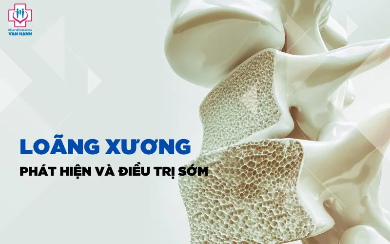 điều trị loãng xương - Image 2