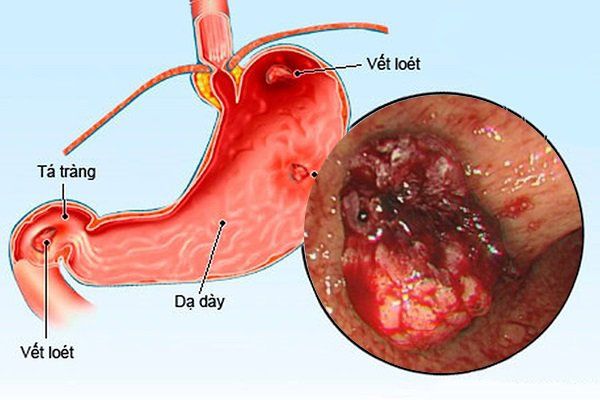 điều trị loét dạ dày
