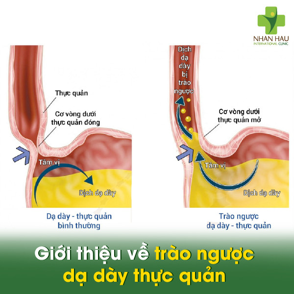 điều trị trào ngược dạ dày - Image 4