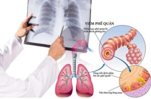 điều trị viêm phế quản