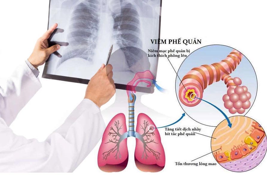 điều trị viêm phế quản