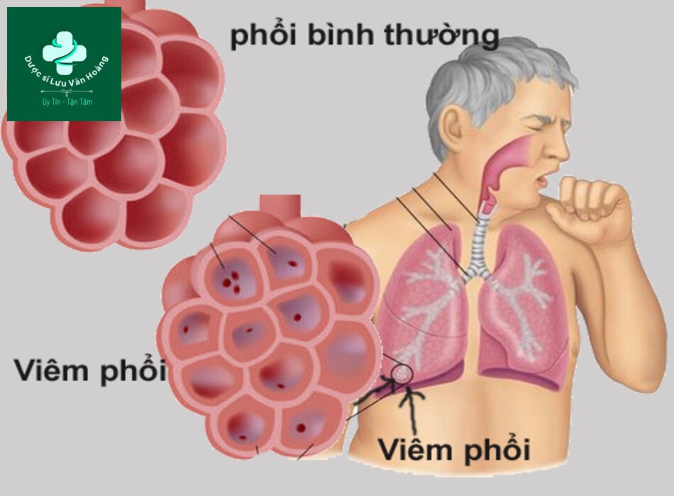 điều trị viêm phổi - Image 2