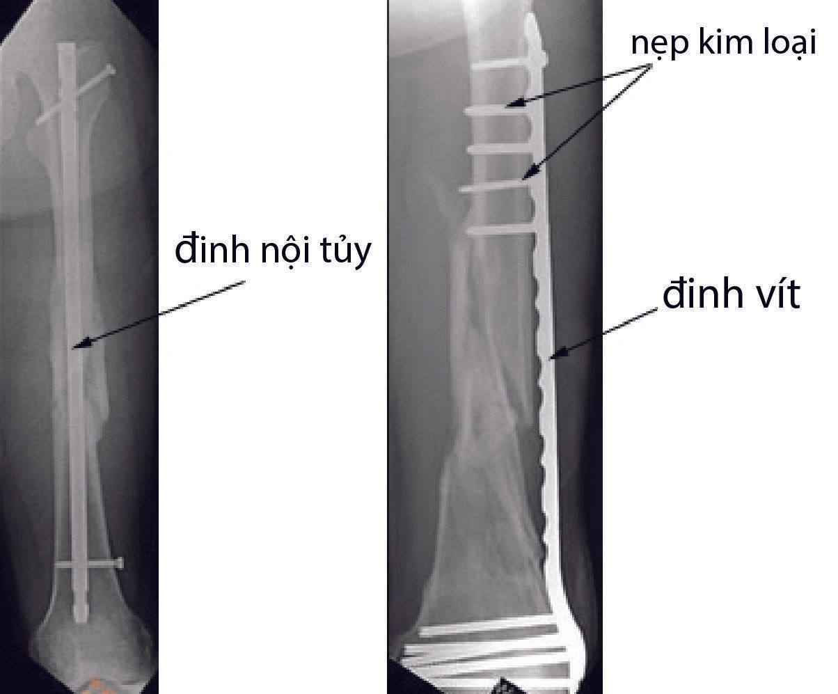 đinh nội tủy - Image 3