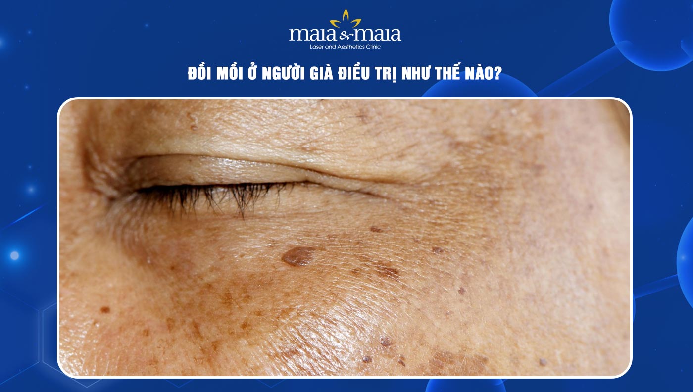 đồi mồi ở người cao tuổi - Image 3