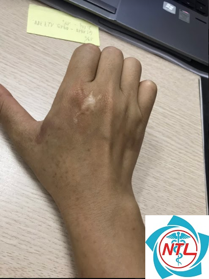 đốm nâu do ánh nắng