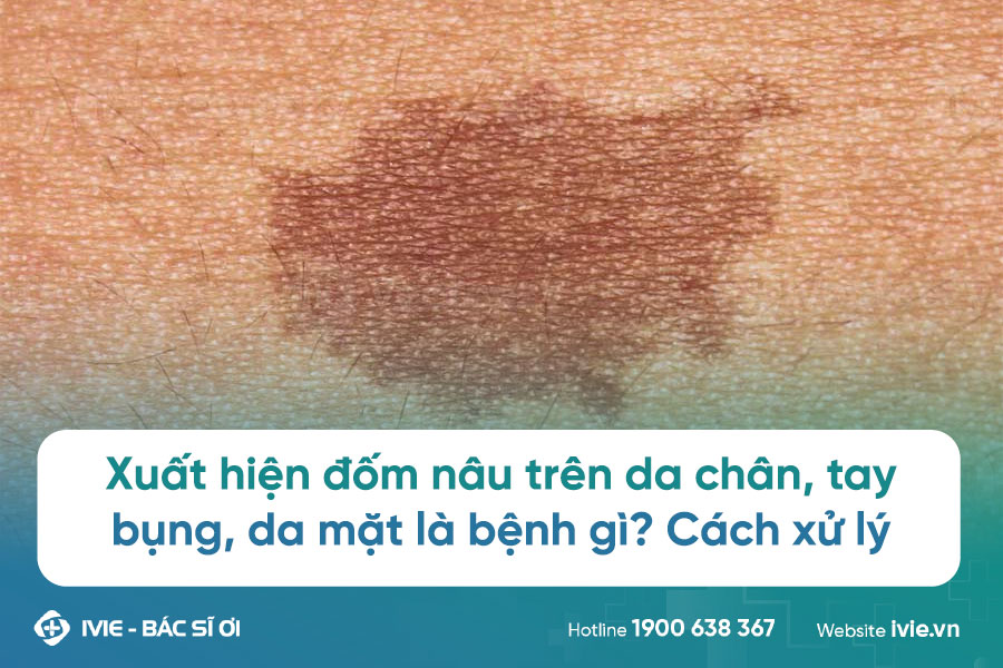 đốm nâu trên da - Image 3