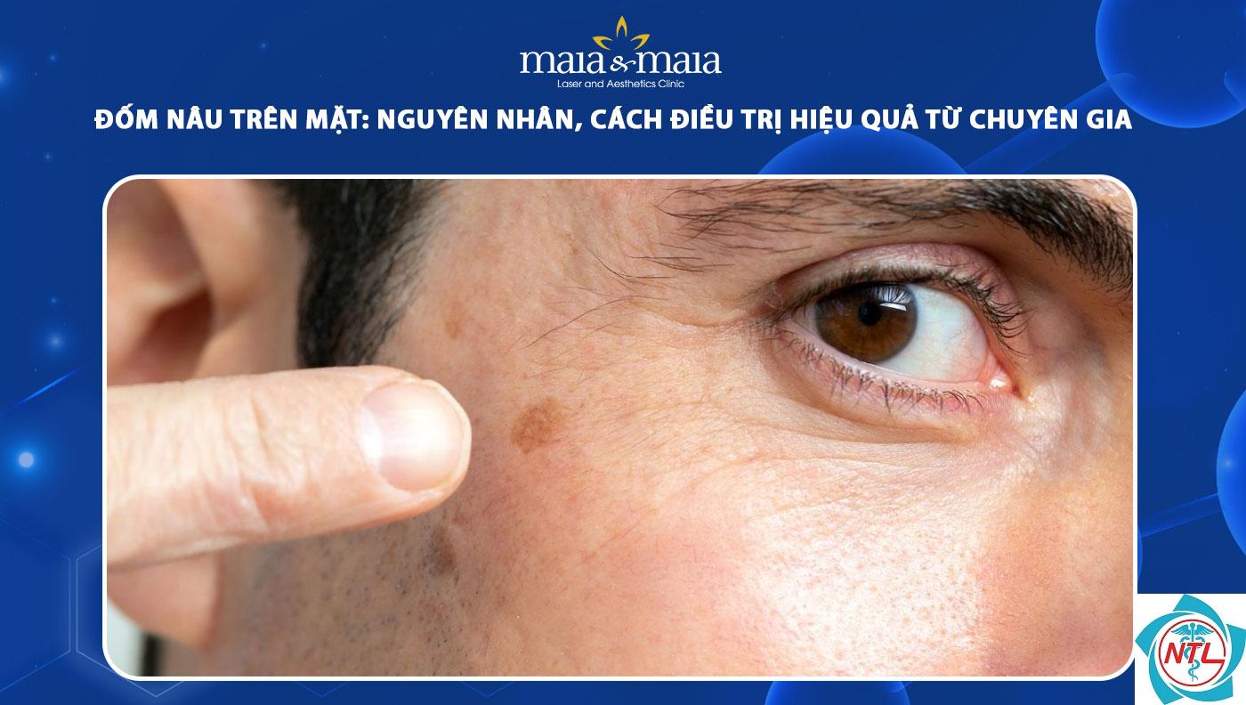 đốm nâu trên mặt - Image 3
