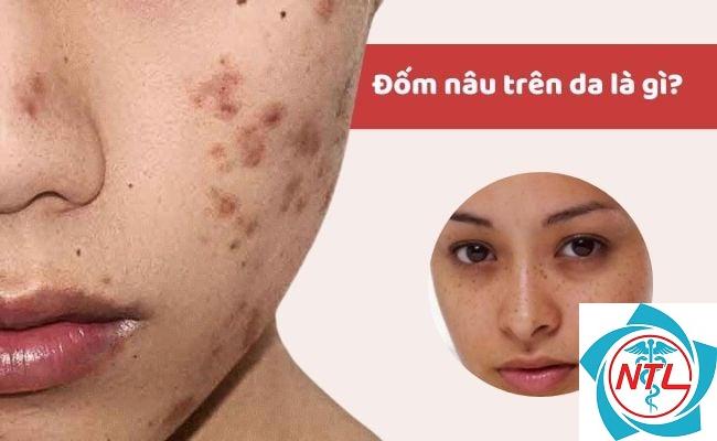 đốm nâu trên mặt - Image 4