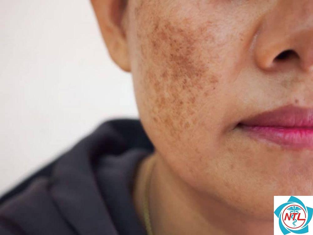 đốm sắc tố trên da - Image 3