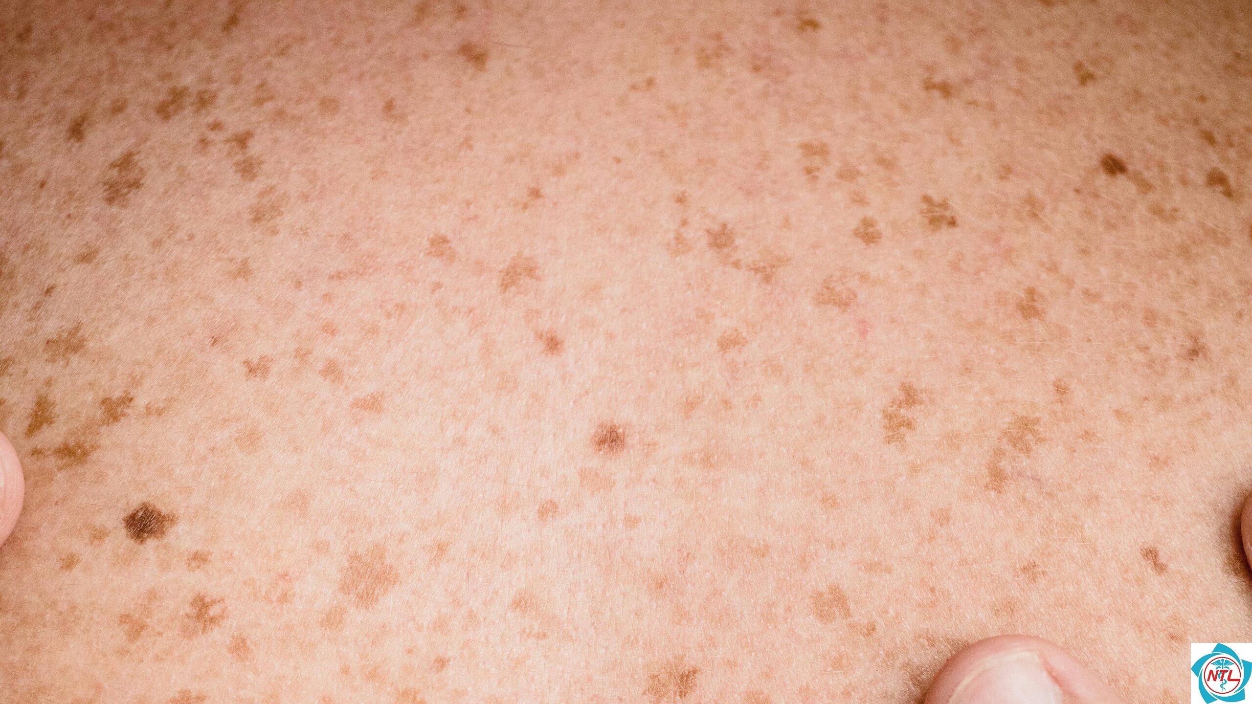đốm sắc tố trên da - Image 4