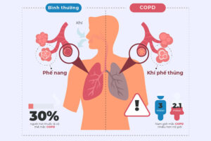 đợt cấp copd