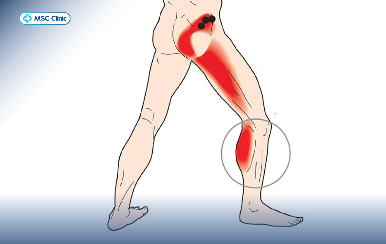 gân kheo nằm ở vị trí nào trên chân - Image 3