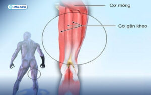 gân kheo nằm ở vị trí nào trên chân