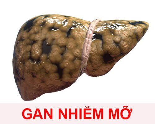 gan nhiễm mỡ - Image 4