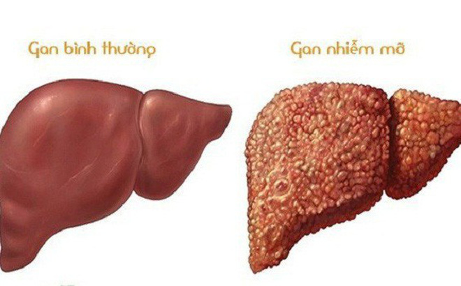 gan nhiễm mỡ có nguy hiểm không - Image 4