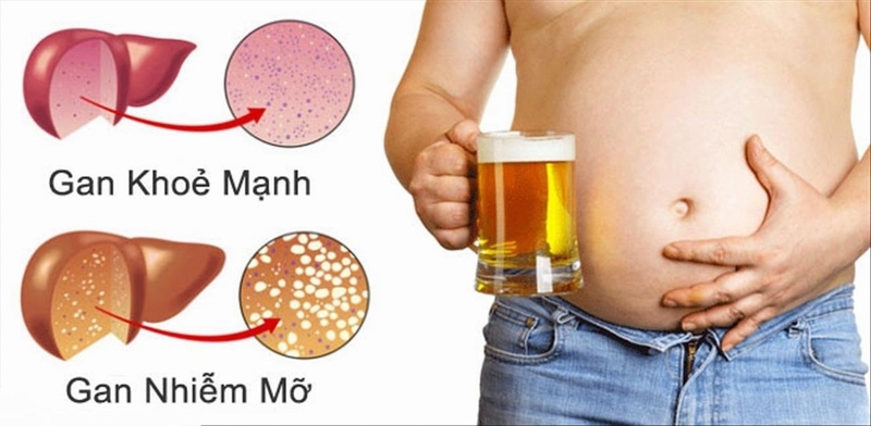 gan nhiễm mỡ có nguy hiểm không - Image 1