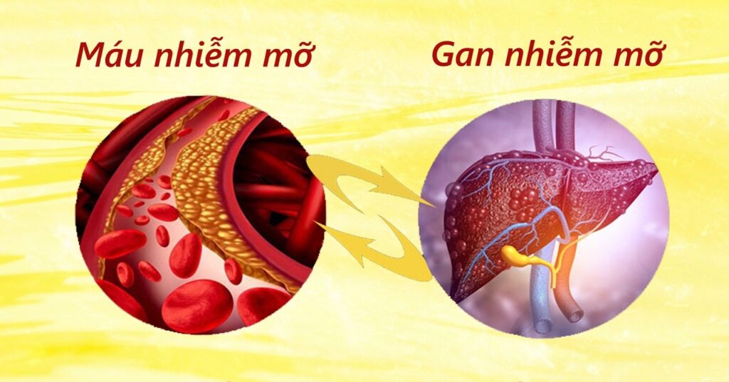 gan nhiễm mỡ kèm mỡ máu cao