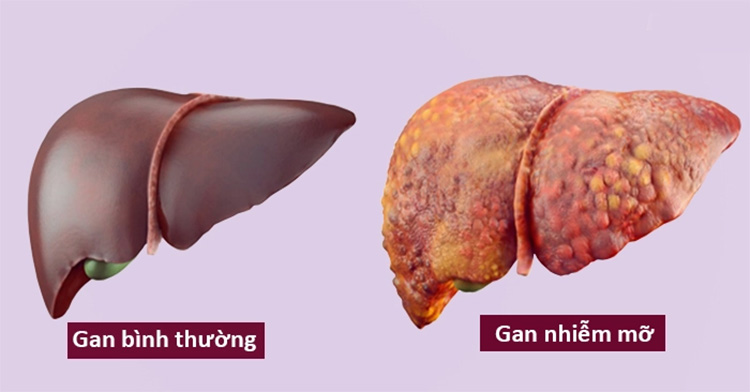 gan nhiễm mỡ kèm mỡ máu cao - Image 2