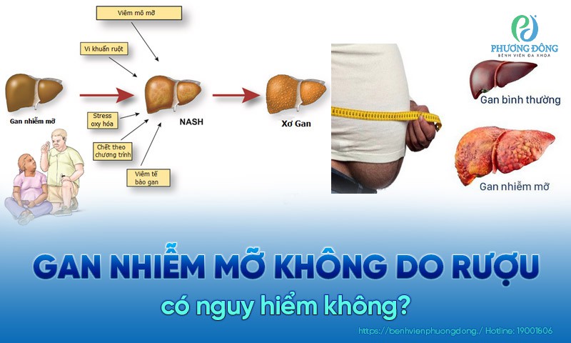 gan nhiễm mỡ không do rượu - Image 4