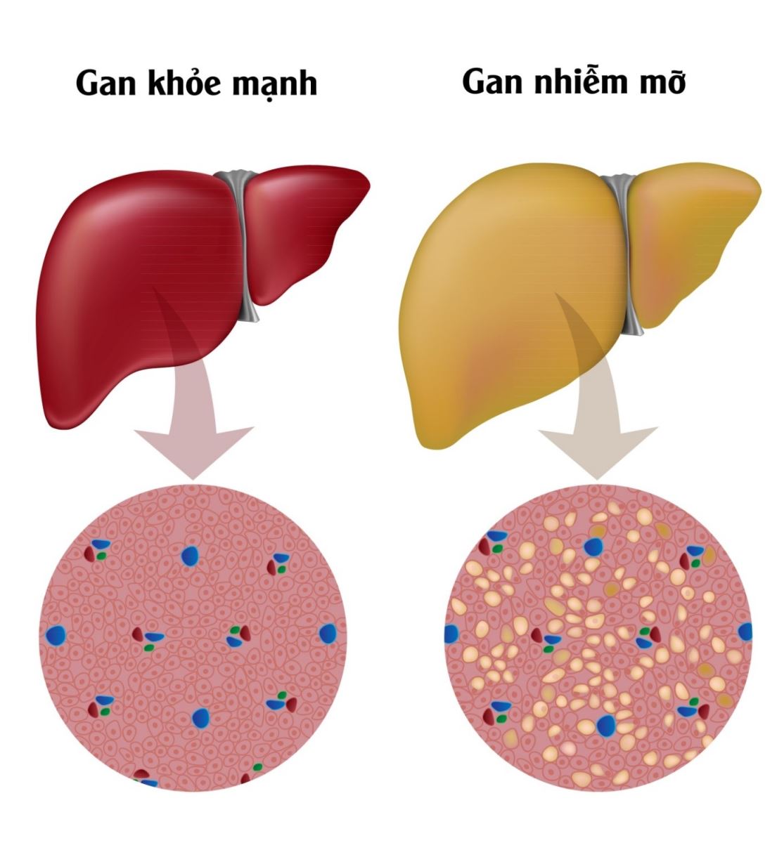 gan nhiễm mỡ là gì - Image 2