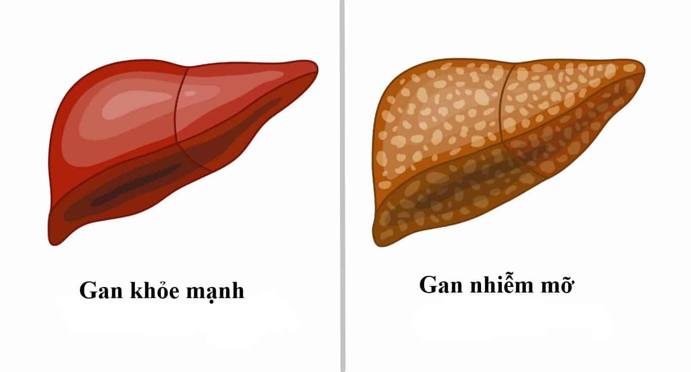 gan nhiễm mỡ là gì - Image 3