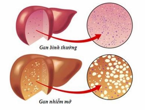 gan nhiễm mỡ là gì - Image 5