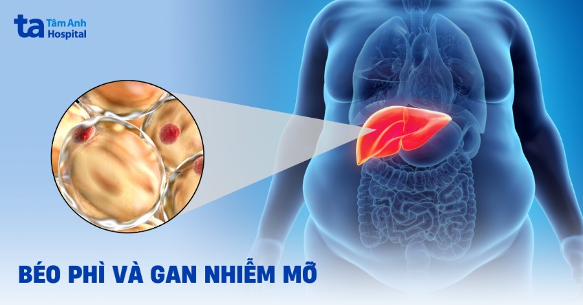 gan nhiễm mỡ ở người béo phì - Image 2