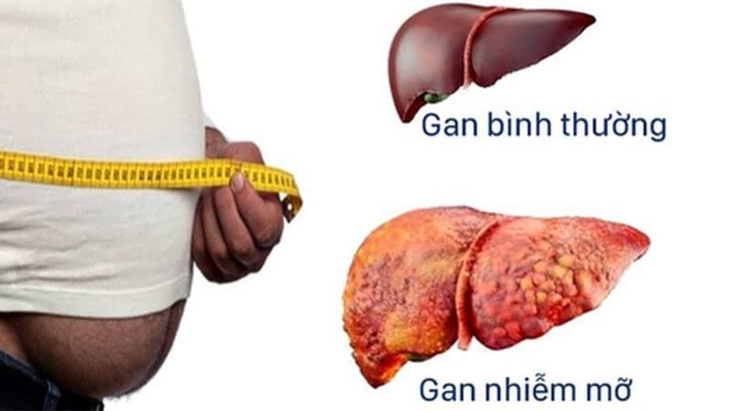gan nhiễm mỡ ở người cao tuổi - Image 3