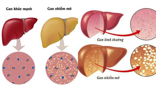 gan nhiễm mỡ ở người cao tuổi - Image 4