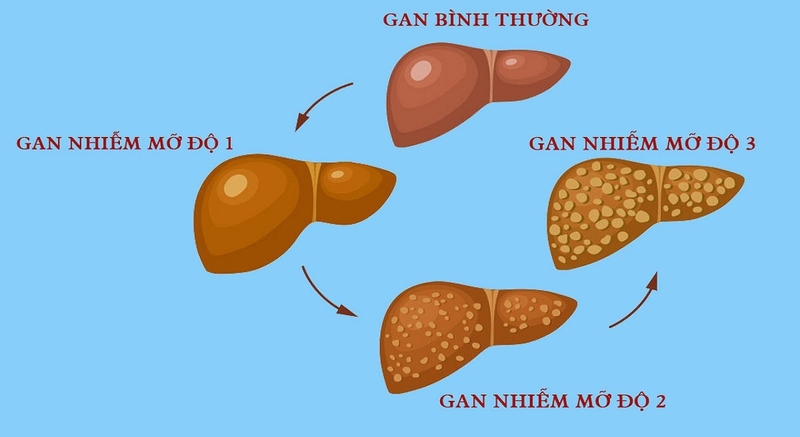 gan nhiễm mỡ ở người tiểu đường - Image 2
