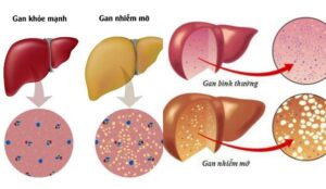 gan nhiễm mỡ ở người tiểu đường