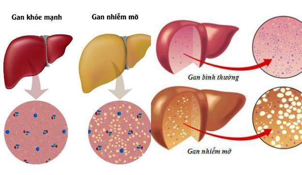 gan nhiễm mỡ ở người tiểu đường