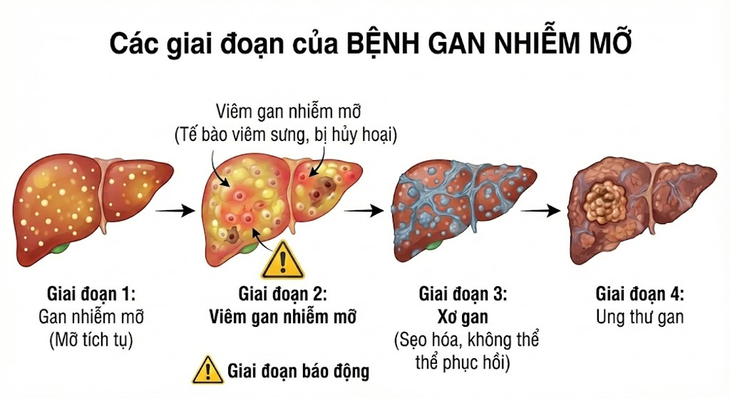 gan nhiễm mỡ tái phát - Image 5