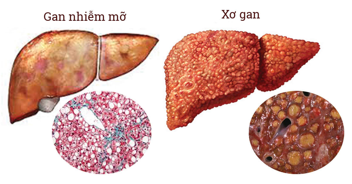 gan nhiễm mỡ tiến triển thành xơ gan - Image 2