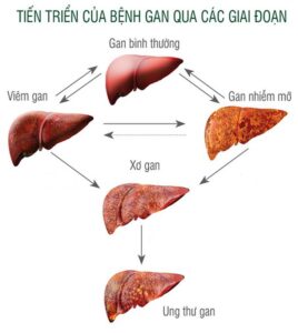 gan nhiễm mỡ tiến triển thành xơ gan