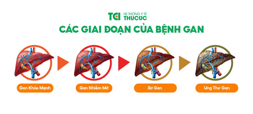 gan nhiễm mỡ tiến triển thành xơ gan - Image 3