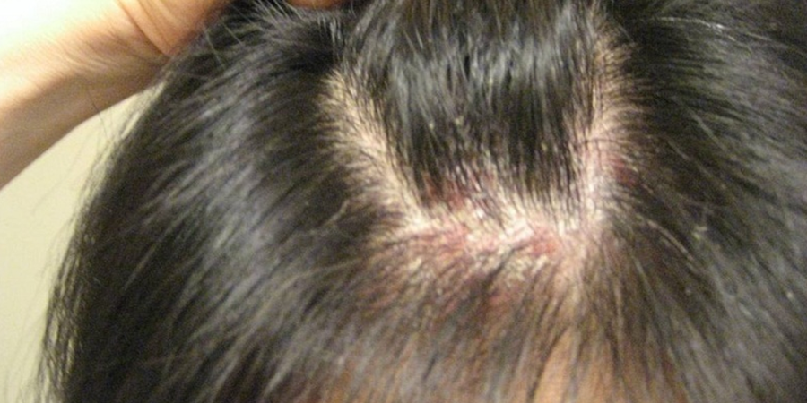 gàu do viêm da tiết bã - Image 5