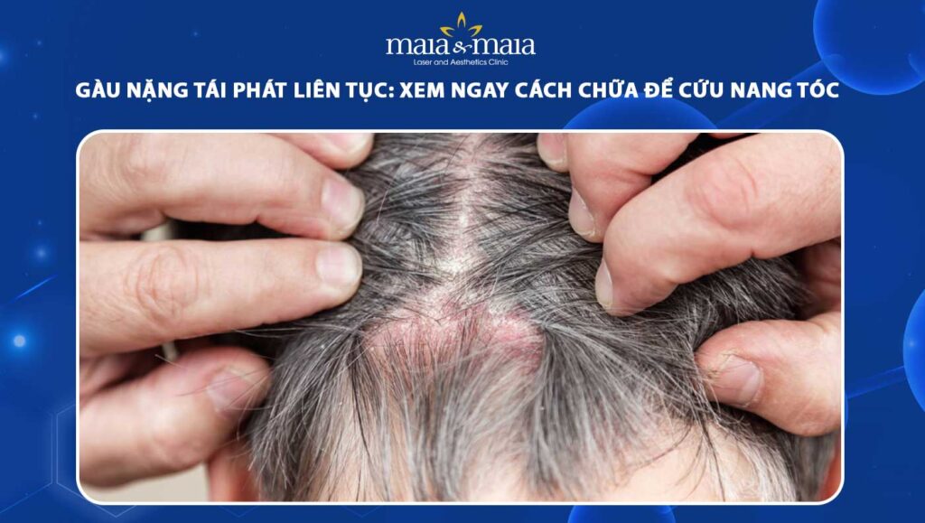 gàu tái phát - Image 2